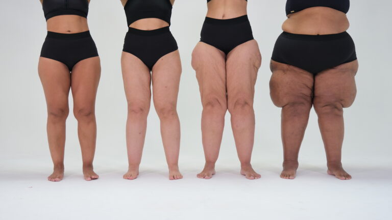 Quando o diagnóstico não chega: o custo invisível do lipedema no Brasil