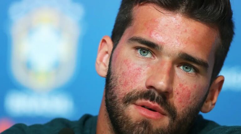 O que é a Rosácea? Dermatologista explica doença revelada pelo goleiro Alisson Becker