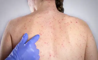 Paulistanos enfrentam filas para tomar vacina contra sarampo