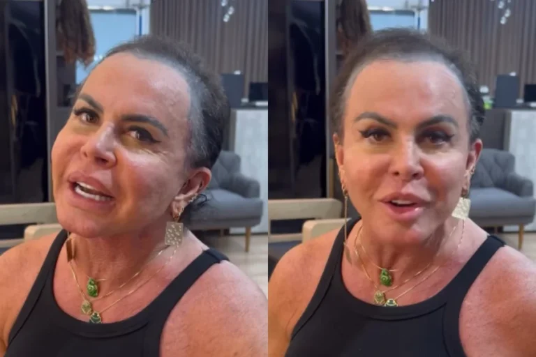 Gretchen coloca transplante capilar em evidência e reacende debate sobre tratamento da alopecia.