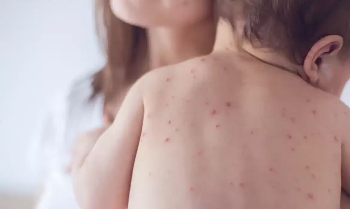 Estado de São Paulo reforça necessidade de vacinação contra o sarampo